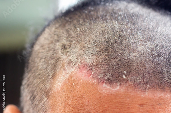 Fototapeta skin disease at the head, Dandruff is a common condition that causes the skin on the scalp to flake