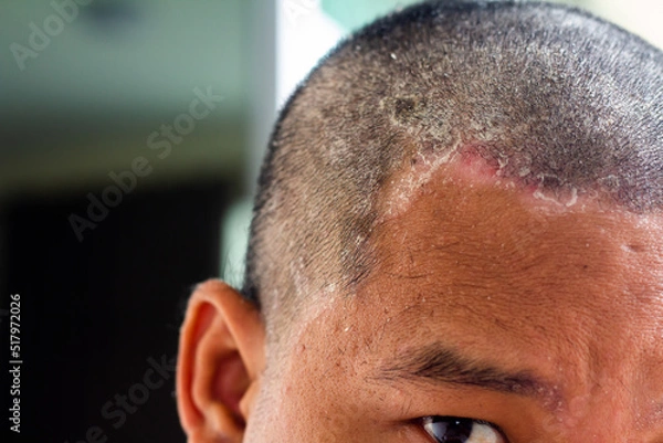 Fototapeta skin disease at the head, Dandruff is a common condition that causes the skin on the scalp to flake