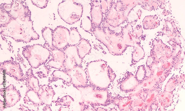 Fototapeta Pathology of a myxopapillary ependymoma, a type of glioma which typically arises in the filum terminale of the spinal cord in adolescents and adults.