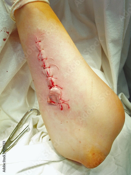 Obraz patient's arm