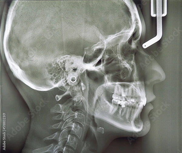 Fototapeta X-ray of the head, jaws. Stages of installing braces. Visiting an orthodontist