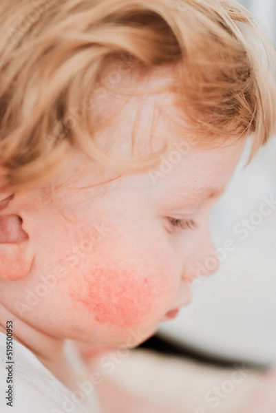 Obraz food allergy in a young child on the cheeks