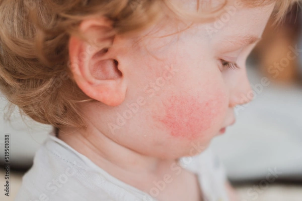Obraz food allergy in a young child on the cheeks
