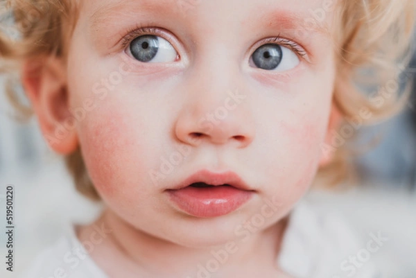 Obraz food allergy in a young child on the cheeks
