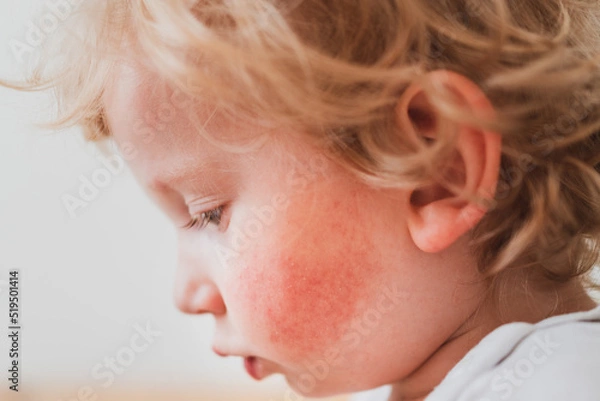 Fototapeta food allergy in a young child on the cheeks