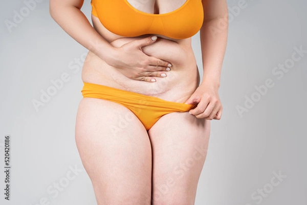 Fototapeta Female belly with a scar from a caesarean section on a gray background