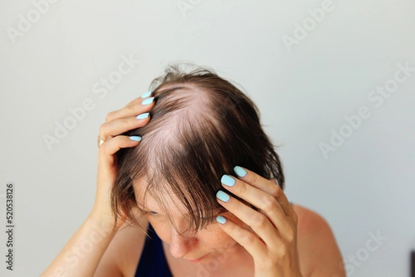 Fototapeta Hair loss in the form of alopecia areata. Bald head of a woman. Hair thinning after covid. Bald patches of total alopecia