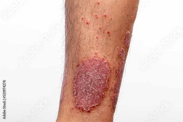 Obraz Psoriasis is that knee on white background.