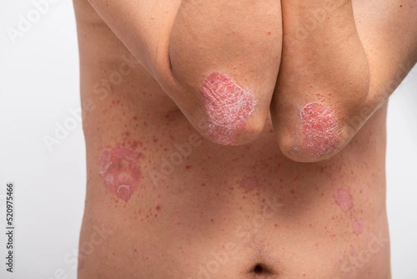 Fototapeta Psoriasis is that elbow on white background.