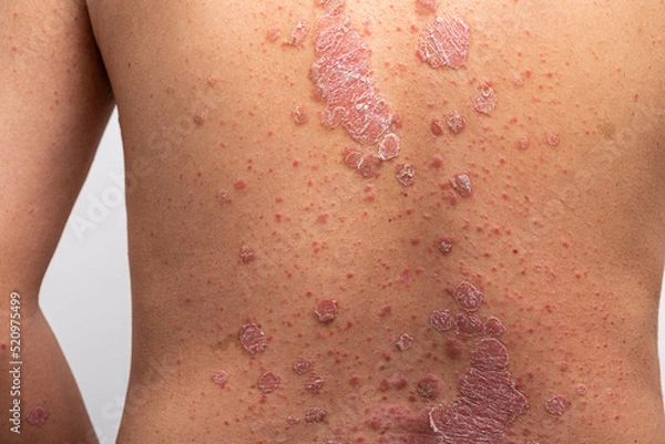 Fototapeta Psoriasis is that back on white background.