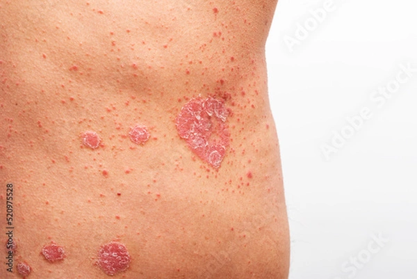 Fototapeta Psoriasis is that back on white background.