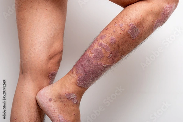 Obraz Psoriasis is that knee on white background.