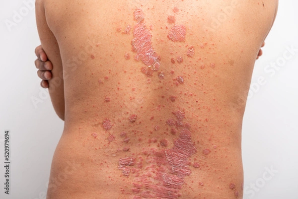Fototapeta Psoriasis is that back on white background.