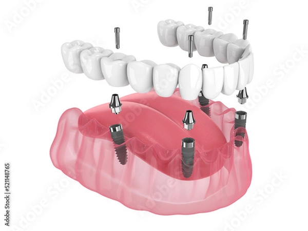 Fototapeta Mandibular prosthesis all on 4 system supported by implants