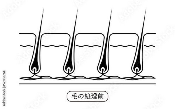 Obraz 脱毛のイメージ、毛の処理前、未処理の状態