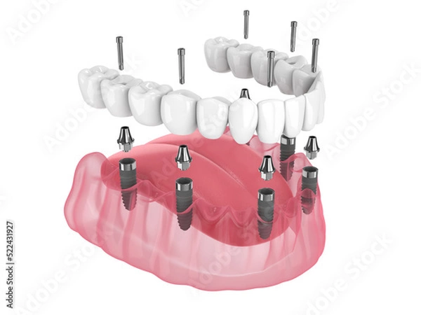 Obraz 3d render of mandibular prosthesis all-on-6 system supported by implants