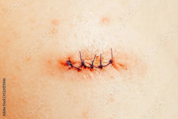 Fototapeta Medical sutures after operations, sewn surgical sutures on the human body