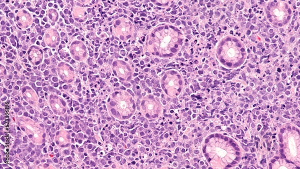 Fototapeta Photomicrograph showing pathology of Burkitt lymphoma, a rare but highly aggressive (fast-growing) B-cell non-Hodgkin lymphoma (NHL), involving colon.