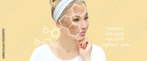Fototapeta Hyperpigmentation: chloasma, melasma , age spots,Post-inflammatory hyperpigmentation.Hyperpigmentation removal