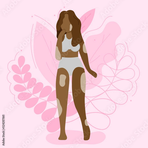 Obraz Vector illustration on the theme of body positivity. A girl with vitiligo, with long wavy hair on a background of beautiful leaves. Flat style