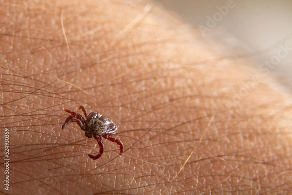 Obraz Crawling deer tick on the background of human hairy skin. Dangerous insect infects with disease
