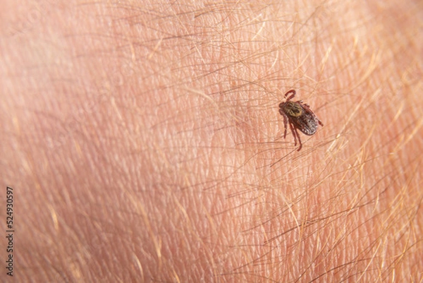 Obraz Crawling deer tick on the background of human hairy skin. Infection through the bite of a dangerous insect with a disease. the concept of infection from insects