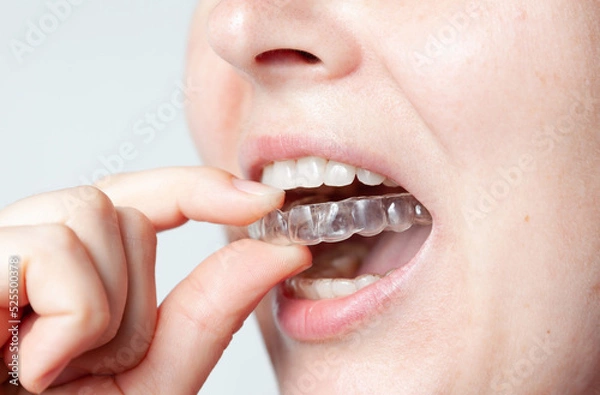 Obraz Caps for teeth after braces hold bite in desired position....