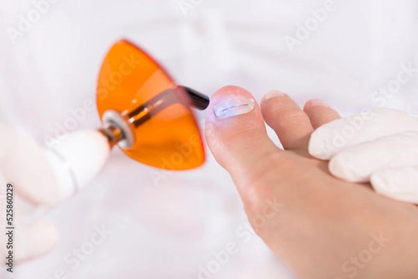 Fototapeta Рodologist (podiatrist) in gloves puts a titanium thread on a toenail with special polymerization ultraviolet lamp. Close-up. Podology and chiropody concept.