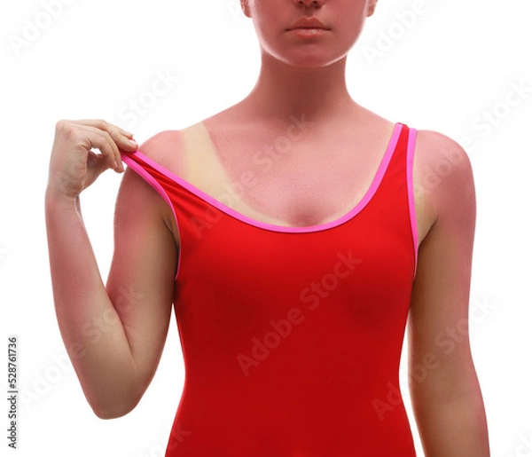 Obraz Woman with sunburned skin on white background, closeup