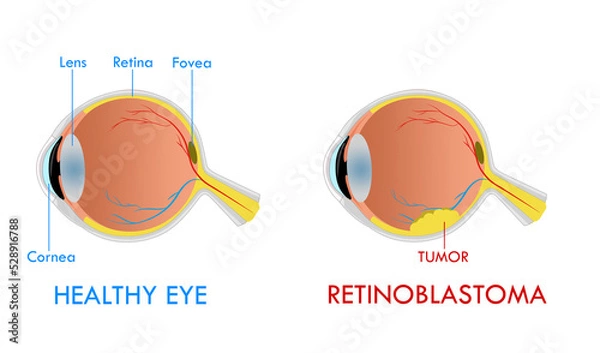 Obraz Retinoblastoma illustration diagram, anatomical scheme. Comparison between healthy eye and damaged eye