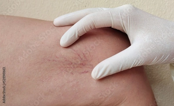 Fototapeta Portrait showing the hand holding the flabbiness skin and varicose veins on the leg, circulation of blood, problem wrinkle and inflammation skin of the patient woman, concept health care.