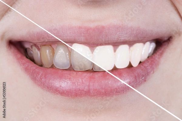 Obraz blanqueamiento dental