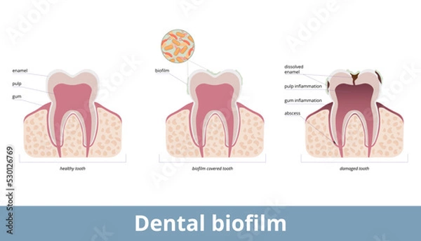 Fototapeta Dental biofilm. Biofilm covers teeth and causes enamel desolvation, inflammation of a gum and pulp. Biofilm on a tooth damages dental tissues, provokes abscess formation.