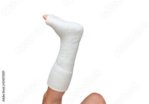 Fototapeta Woman with her broken leg. leg in a cast on isolated white background. Close up
