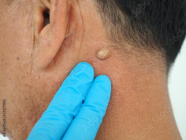 Obraz Man pointed to sebaceous cysts on his neck, formed by sebaceous glands. Oils called sebum and laser skin treatments or flea biopsies health concept. closeup photo, blurred.