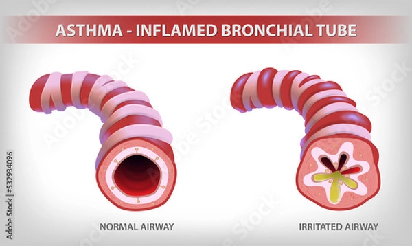 Fototapeta The illustration shows two parts of the bronchi, one normal and the other bronchitis and filled with sputum. use in medical and educational