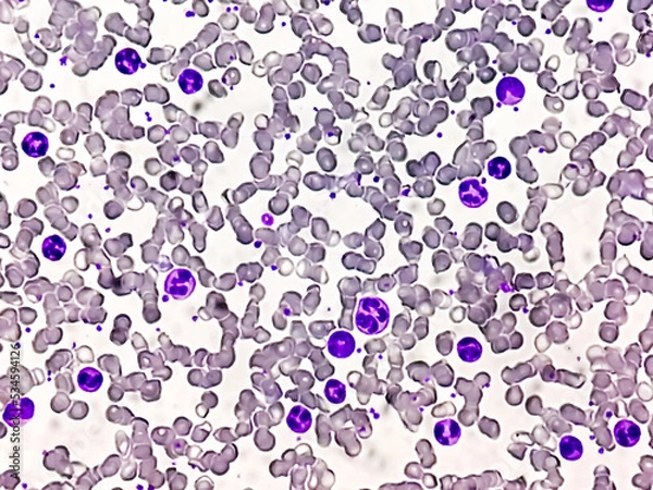 Fototapeta Chronic myelogenous leukemia (CML), also known as chronic myeloid leukemia, is a cancer of the white blood cells. chronic granulocytic leukemia 