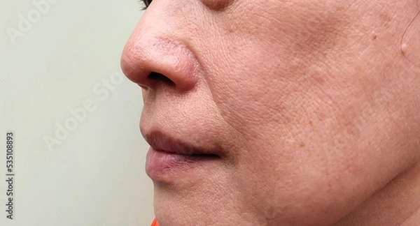 Fototapeta Portrait showing the flabbiness adipose sagging skin, dark spots and blemish on the cheek, dull skin and wrinkles corner of the mouth, Flabby skin on the face of the woman, concept health care.