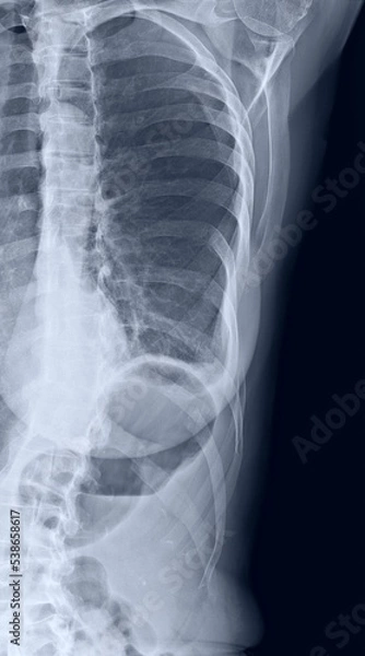 Fototapeta Costal x-ray of coast sternum and clavicle