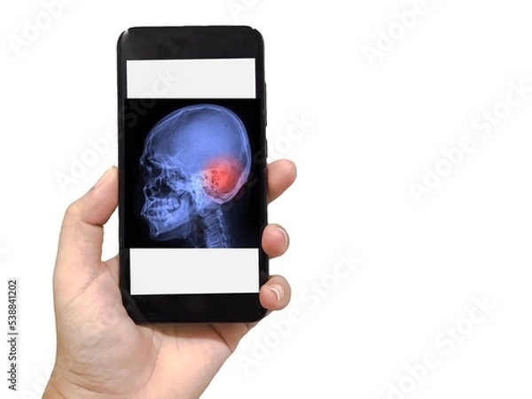 Fototapeta Doctor woman hand holding smartphone has X-ray skull with cerebral vascular accident (CVA) on white background. Medical and healthcare concept