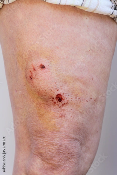 Fototapeta Accident, dog bite, puncture wound on human leg