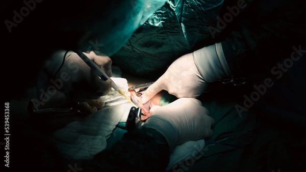 Fototapeta Doctors performing an appendectomy surgery, surgical concept.
