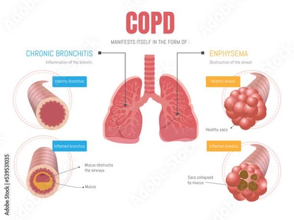 Obraz Epoc infographic: manifests itself in two forms emphysema and bronchitis 