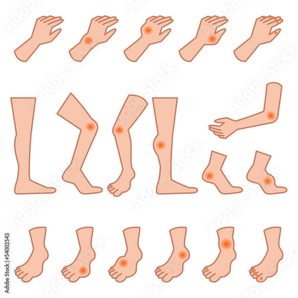 Fototapeta 痛風と捻挫の手足セット