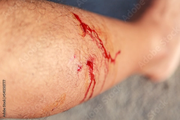 Obraz Dog bite wound on leg