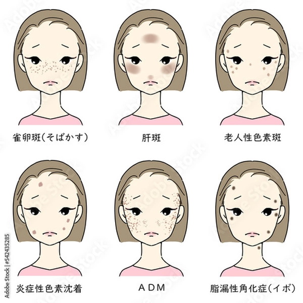 Fototapeta シミ・そばかすに悩む女性セット　シミの種類　文字あり　