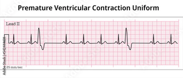 Fototapeta ECG Premature Ventricular Contraction Uniform - Unifocal - 8 Second ECG Paper - Ventricular Extrasystole