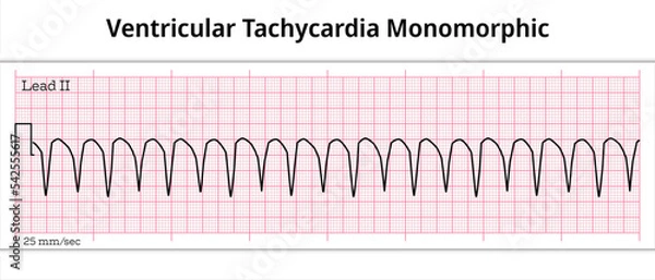 Fototapeta ECG Ventricular Tachycardia – Monomorphic VT - 8 Second ECG Paper