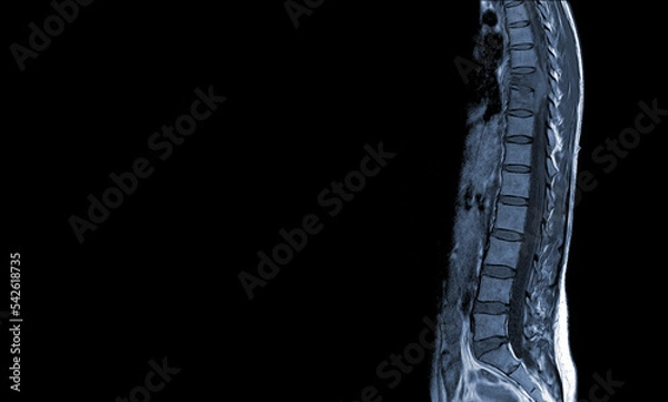 Obraz MRI of thoracic spine Moderate pathologic compression fracture of T9 vertebral body with paravertebral abscess at T9-10.