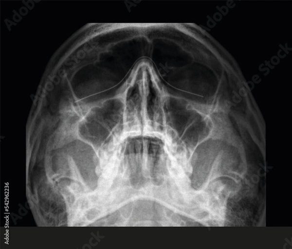 Fototapeta Face x-ray. Radiography below view of a womans face